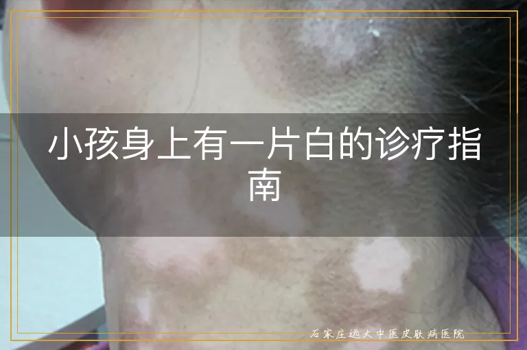 小孩身上有一片白的诊疗指南