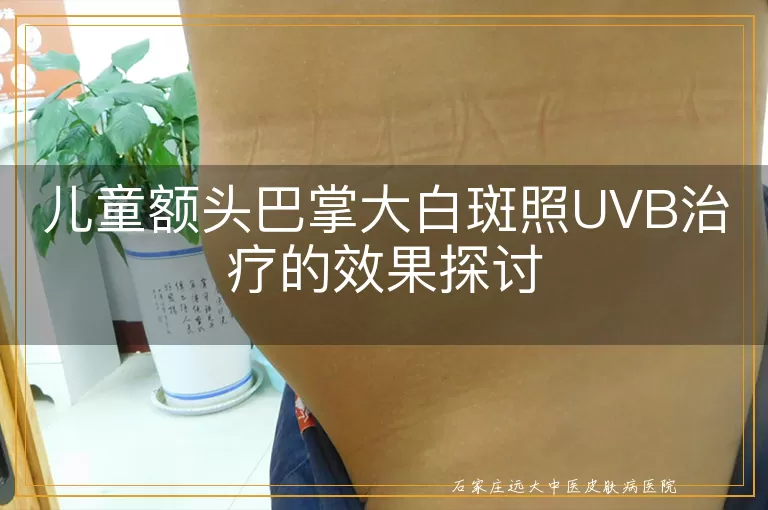儿童额头巴掌大白斑照UVB治疗的效果探讨