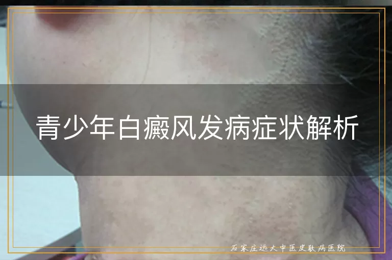 青少年白癜风发病症状解析