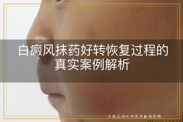 白癜风抹药好转恢复过程的真实案例解析