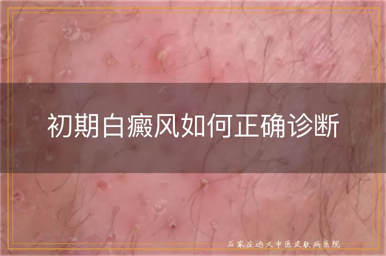 初期白癜风如何正确诊断