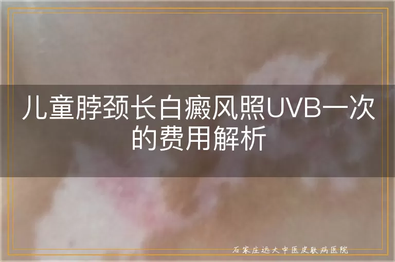 儿童脖颈长白癜风照UVB一次的费用解析