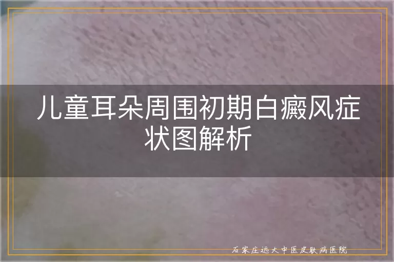 儿童耳朵周围初期白癜风症状图解析