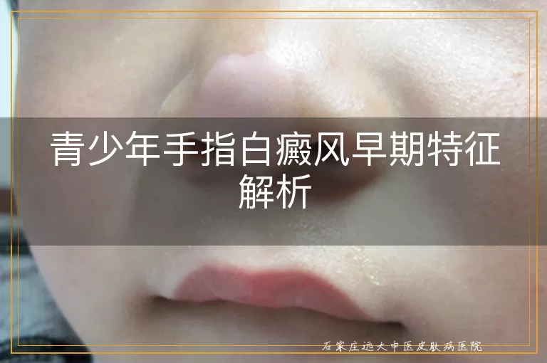 青少年手指白癜风早期特征解析