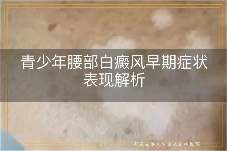 青少年腰部白癜风早期症状表现解析