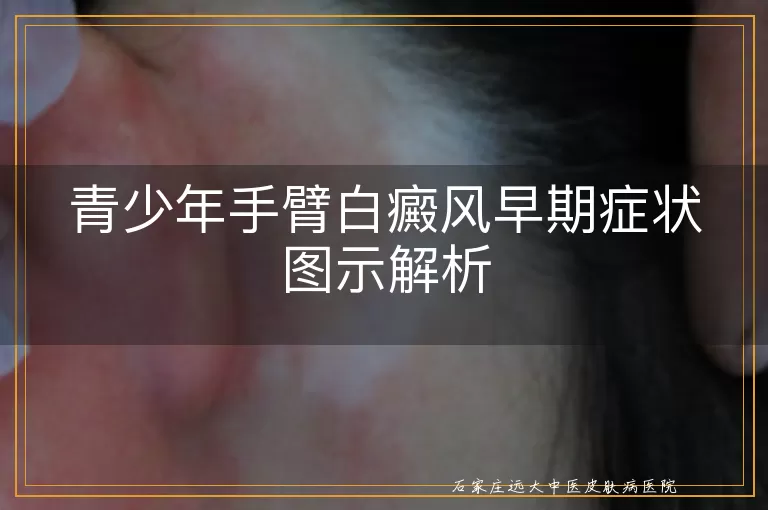青少年手臂白癜风早期症状图示解析