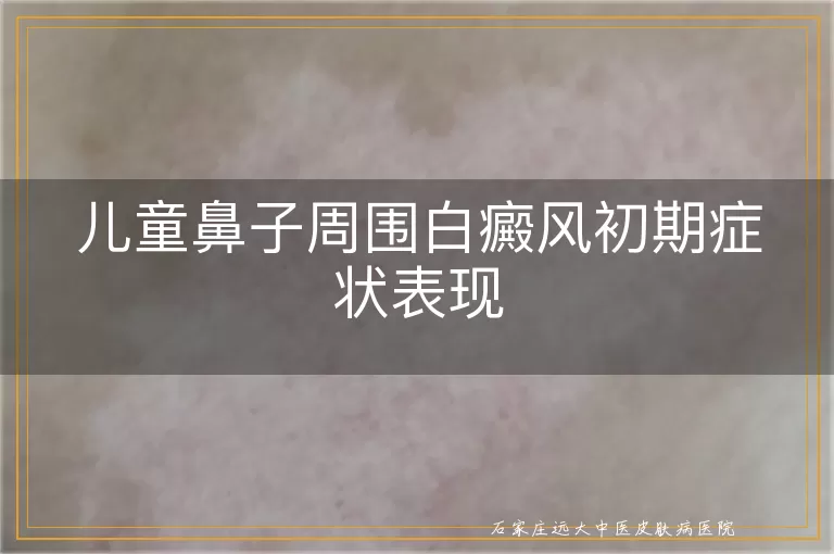 儿童鼻子周围白癜风初期症状表现