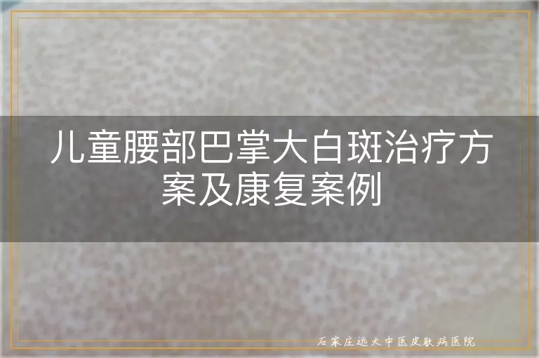 儿童腰部巴掌大白斑治疗方案及康复案例