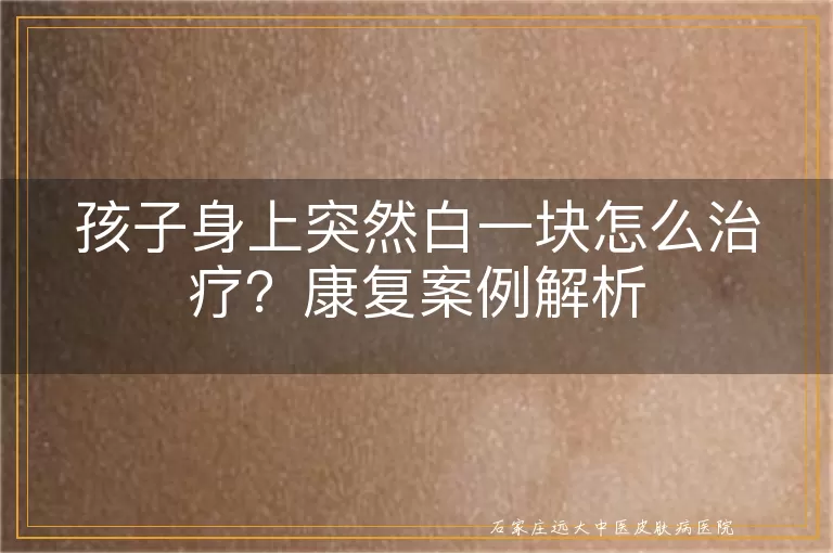 孩子身上突然白一块怎么治疗？康复案例解析