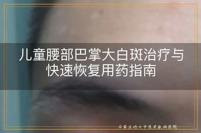 儿童腰部巴掌大白斑治疗与快速恢复用药指南