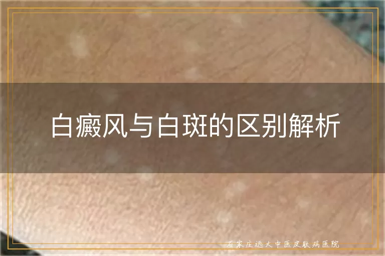 白癜风与白斑的区别解析