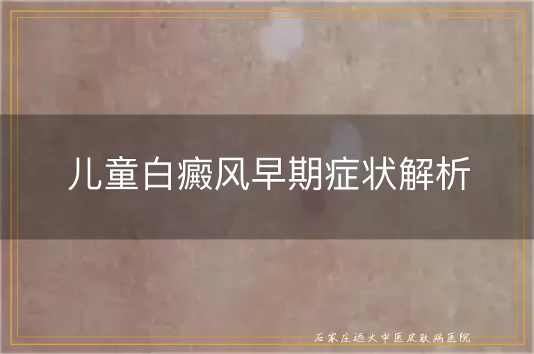 儿童白癜风早期症状解析