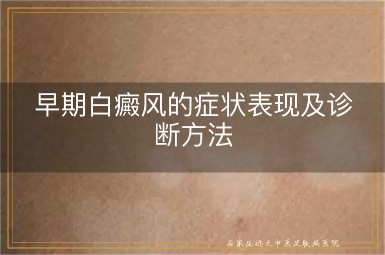 早期白癜风的症状表现及诊断方法