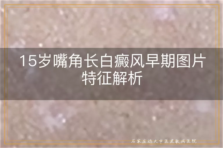15岁嘴角长白癜风早期图片特征解析