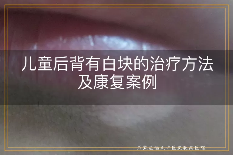 儿童后背有白块的治疗方法及康复案例