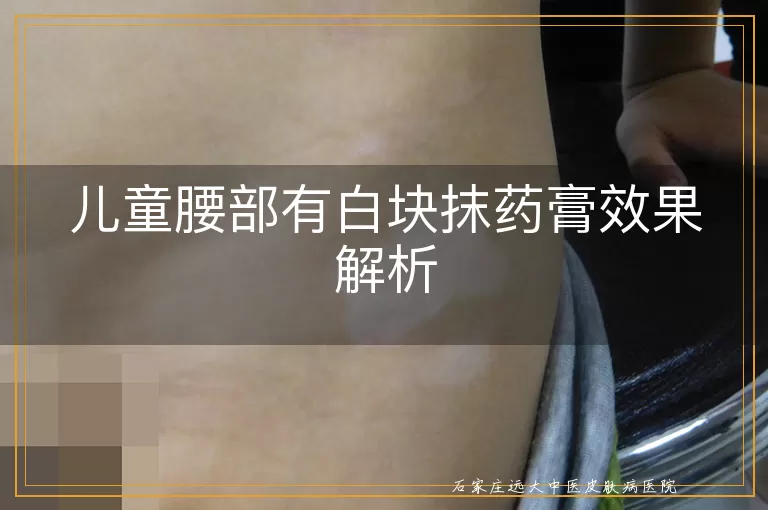 儿童腰部有白块抹药膏效果解析