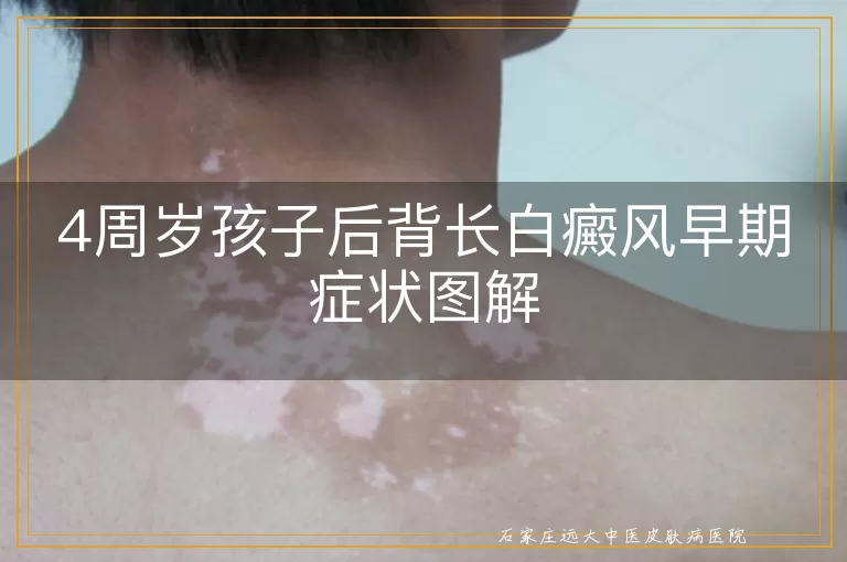 4周岁孩子后背长白癜风早期症状图解