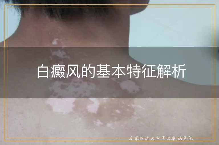 白癜风的基本特征解析