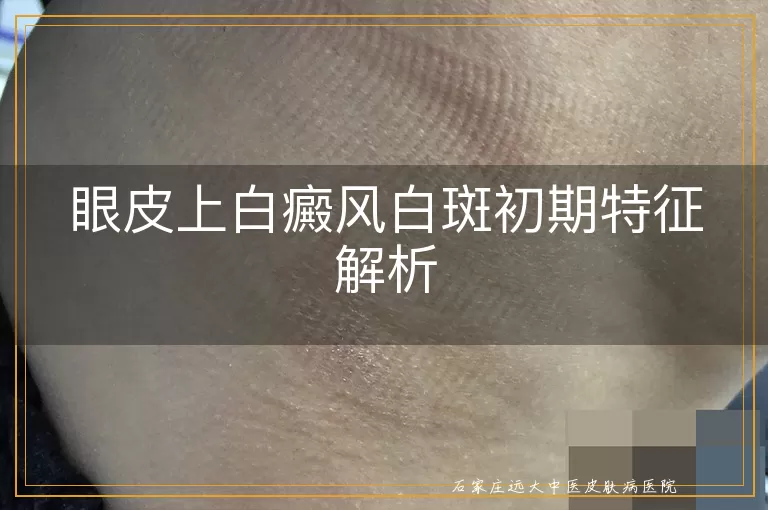 眼皮上白癜风白斑初期特征解析