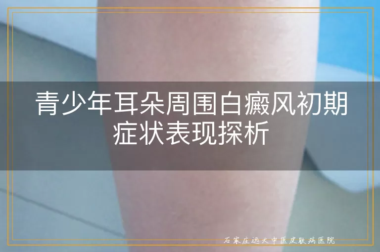 青少年耳朵周围白癜风初期症状表现探析