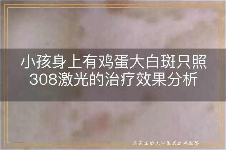 小孩身上有鸡蛋大白斑只照308激光的治疗效果分析