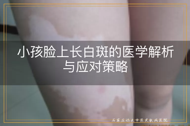 小孩脸上长白斑的医学解析与应对策略