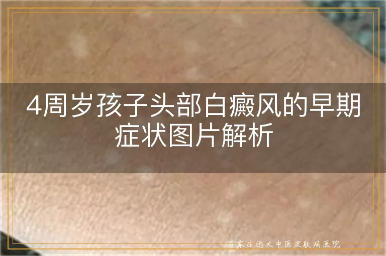 4周岁孩子头部白癜风的早期症状图片解析