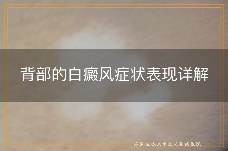 背部的白癜风症状表现详解