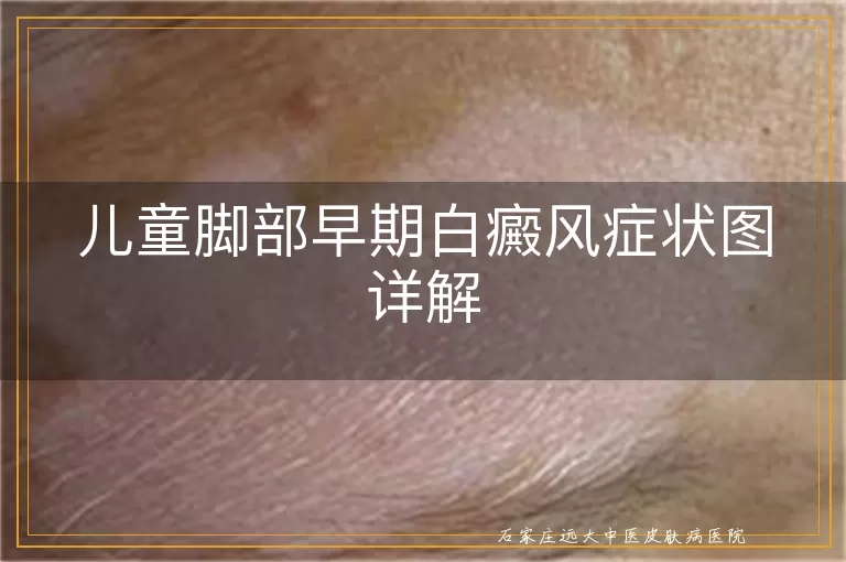 儿童脚部早期白癜风症状图详解