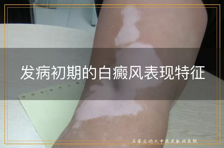 发病初期的白癜风表现特征