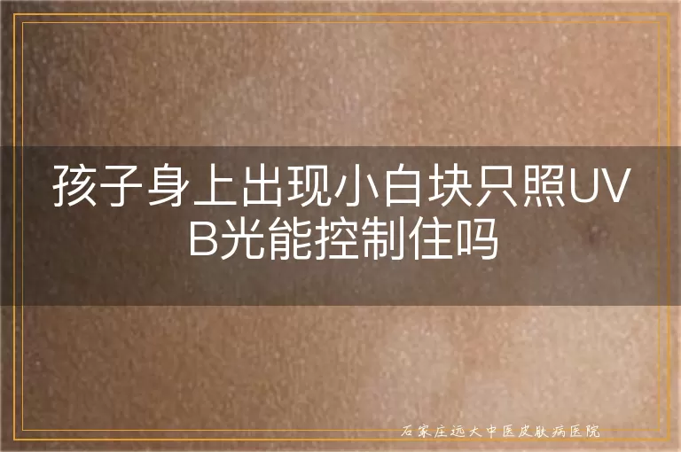 孩子身上出现小白块只照UVB光能控制住吗