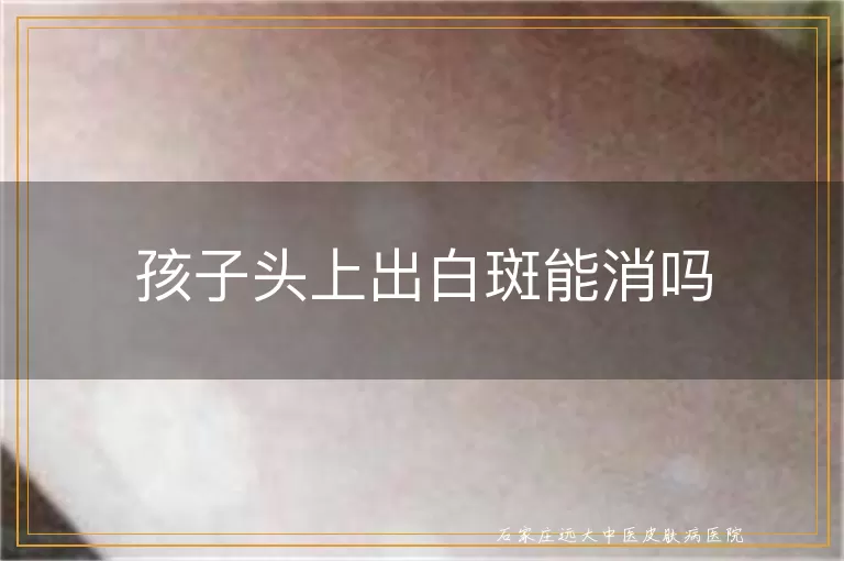 孩子头上出白斑能消吗