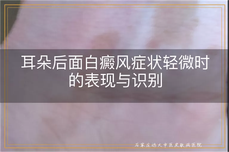 耳朵后面白癜风症状轻微时的表现与识别