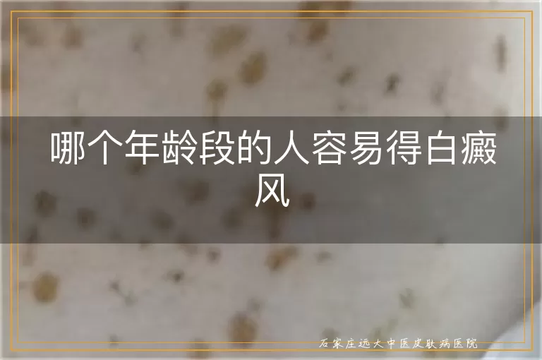 哪个年龄段的人容易得白癜风