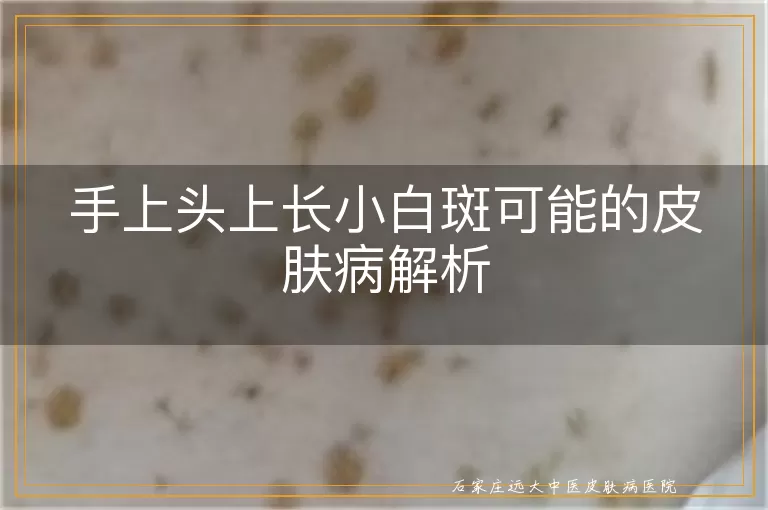 手上头上长小白斑可能的皮肤病解析