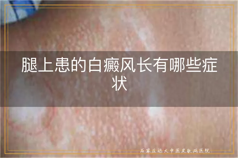腿上患的白癜风长有哪些症状