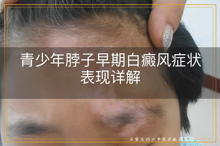 青少年脖子早期白癜风症状表现详解