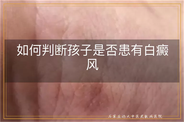 如何判断孩子是否患有白癜风