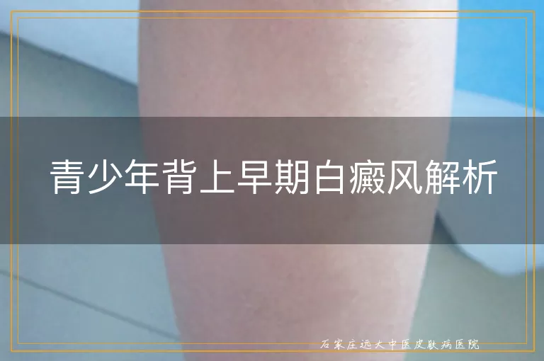 青少年背上早期白癜风解析