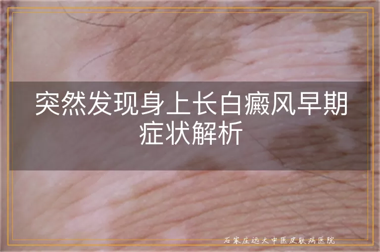 突然发现身上长白癜风早期症状解析