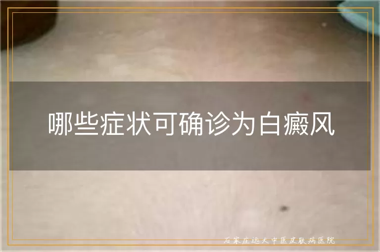 哪些症状可确诊为白癜风