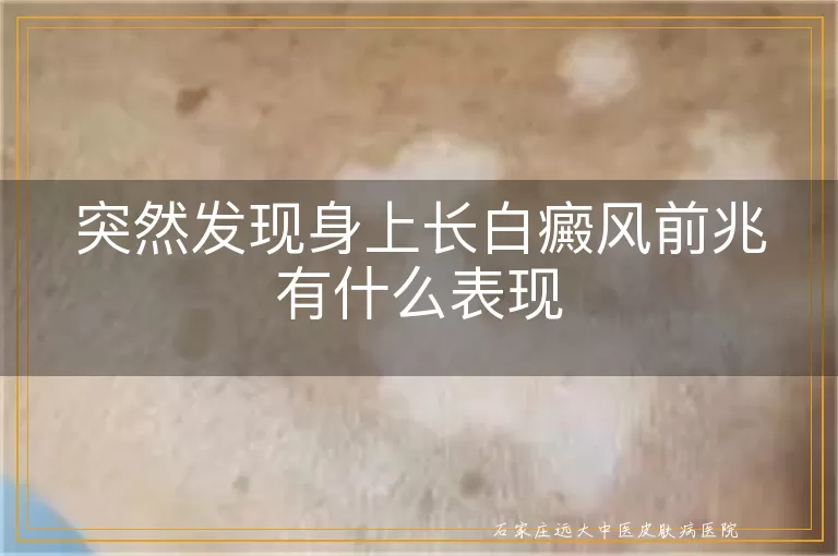 突然发现身上长白癜风前兆有什么表现