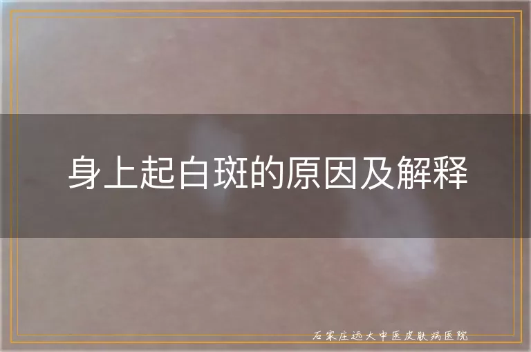 身上起白斑的原因及解释