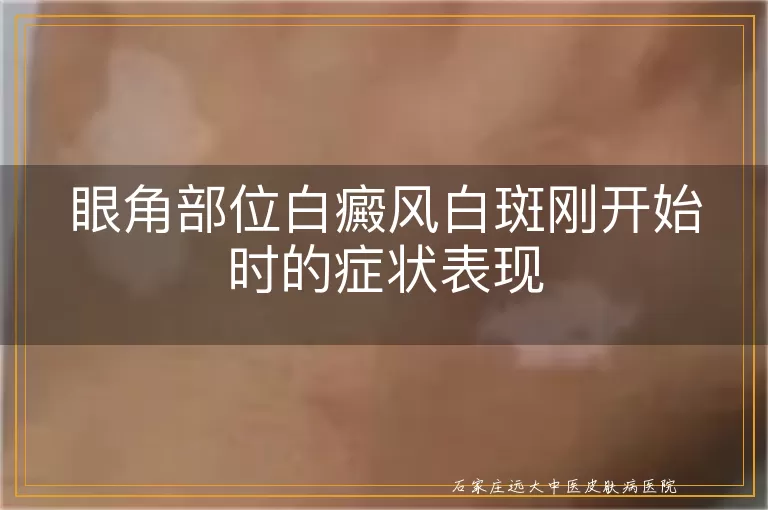 眼角部位白癜风白斑刚开始时的症状表现