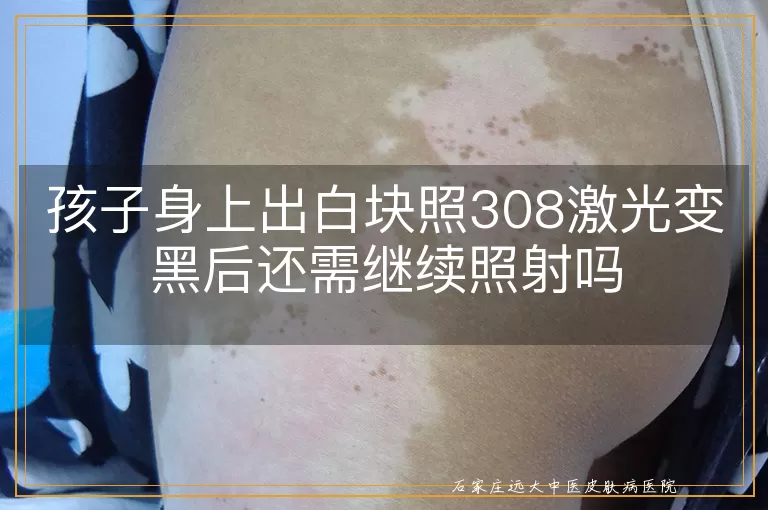 孩子身上出白块照308激光变黑后还需继续照射吗