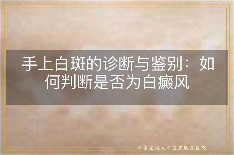 手上白斑的诊断与鉴别：如何判断是否为白癜风