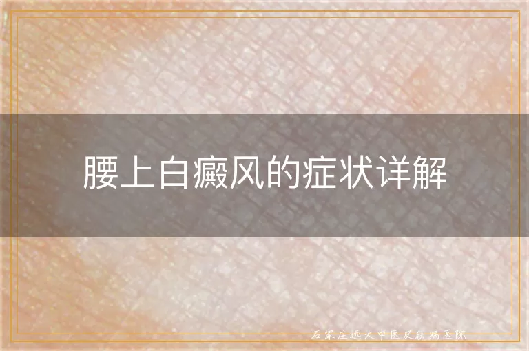 腰上白癜风的症状详解