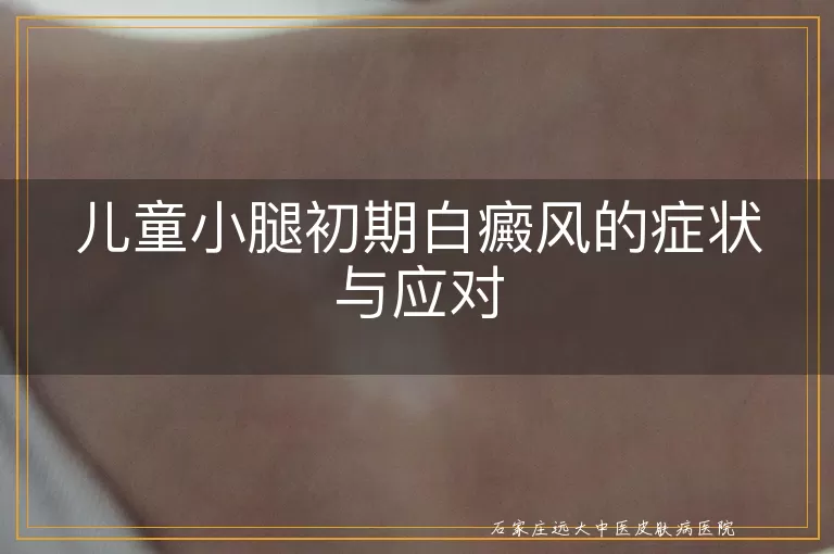 儿童小腿初期白癜风的症状与应对