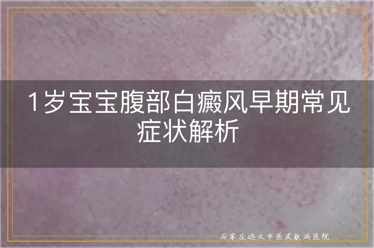 1岁宝宝腹部白癜风早期常见症状解析