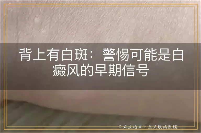 背上有白斑：警惕可能是白癜风的早期信号
